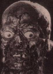 Pleurisy : My Favourite Girl